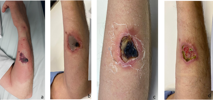 Progressie van cutaan loxoscelisme